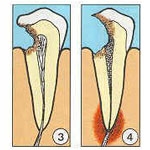 3: Einbruch der Karies in das Zahnmark. 4: Eitriger Zerfall des Zahnmarks (nach Hey). Grafik: MDZ.